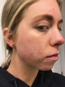 My Skin Story: How I naturally cleared my acne